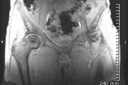 Total Hip Replacemnt Recovery Fund photo