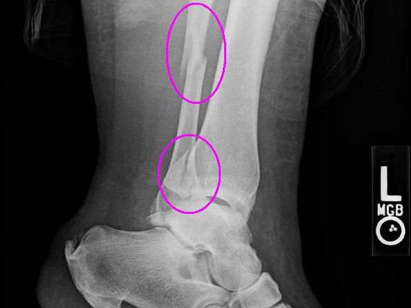 Fundraiser by Bsma Hensley Broken Ankle No Insurance