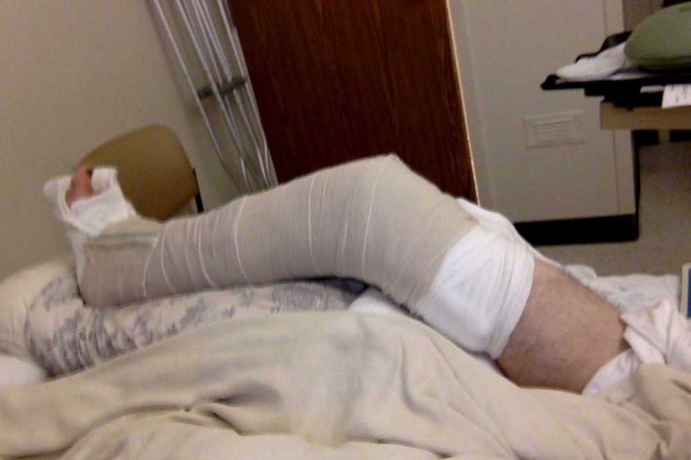 leg broken injury osteomyelitis gofundme nicholas thibeault vallejo fundraiser nick