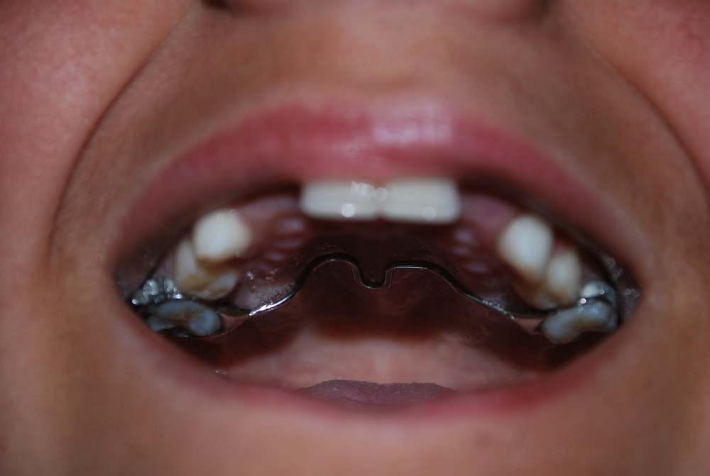 teeth molars fall gofundme harison leave