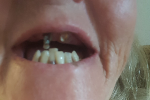 Oral Surgery Dentures 117