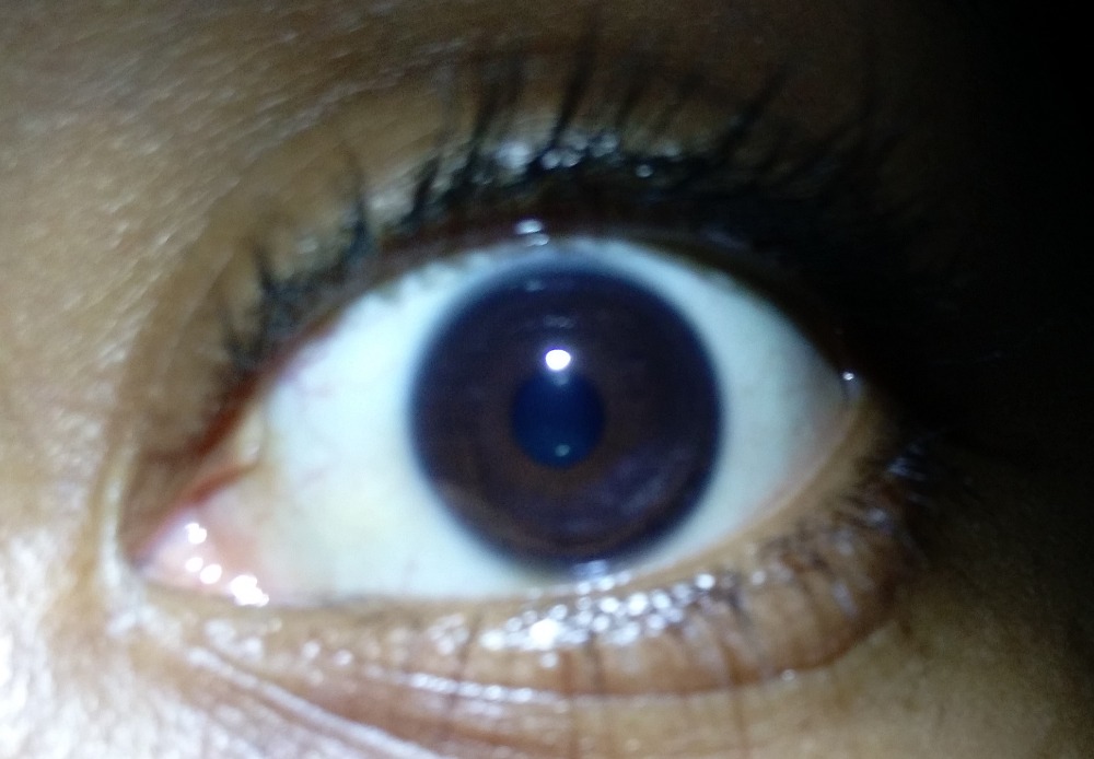 Is it normal for a black person to have a blue ring around their brown eyes?  - Quora
