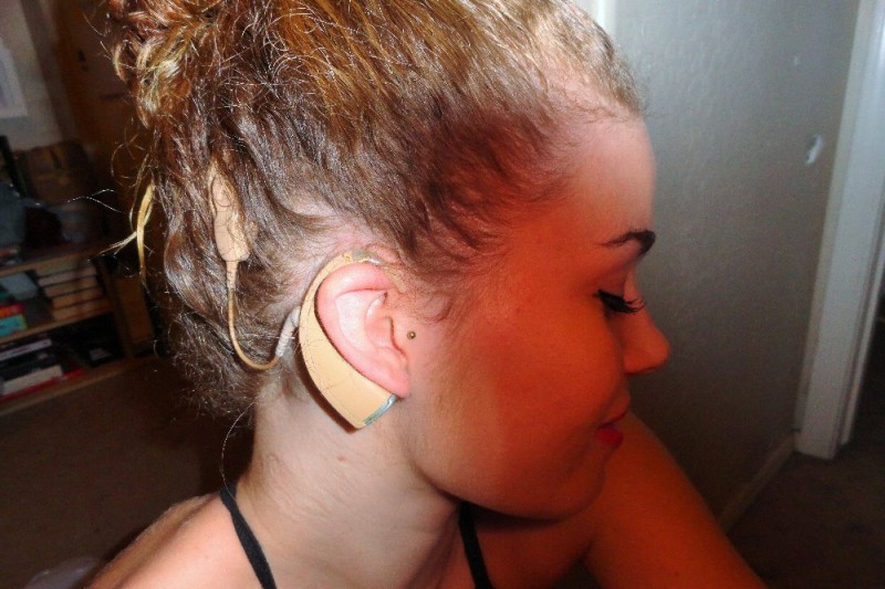 Fundraiser by Chris Johnson NEW COCHLEAR IMPLANT &amp; INSTALL