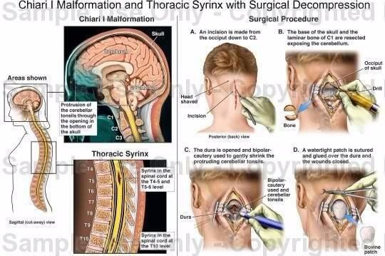 fundraiser-by-angie-duncan-simmons-post-brain-surgery-bills-chiari