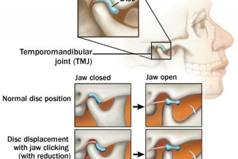 Fundraiser by Kaylee Richardson TMJ(Jaw) therapy/surgery for Kaylee